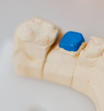 Jak rozpoznać pierwsze objawy zapalenia wokół implantu?